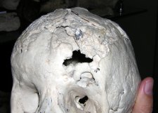 Cráneo de un individuo muerto por sífilis